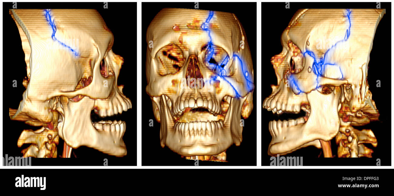 3d Ct Scan Image D Une Fracture Du Crane Photo Stock Alamy