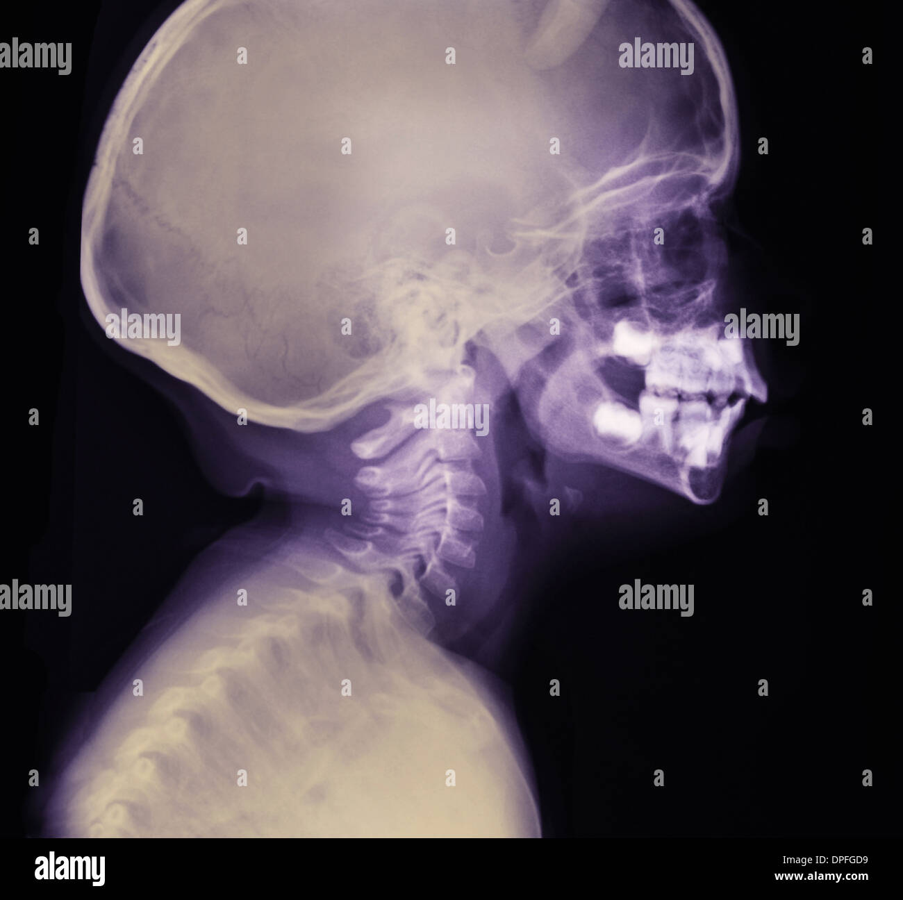 X-ray montrant la tête d'un garçon de 2 ans Banque D'Images