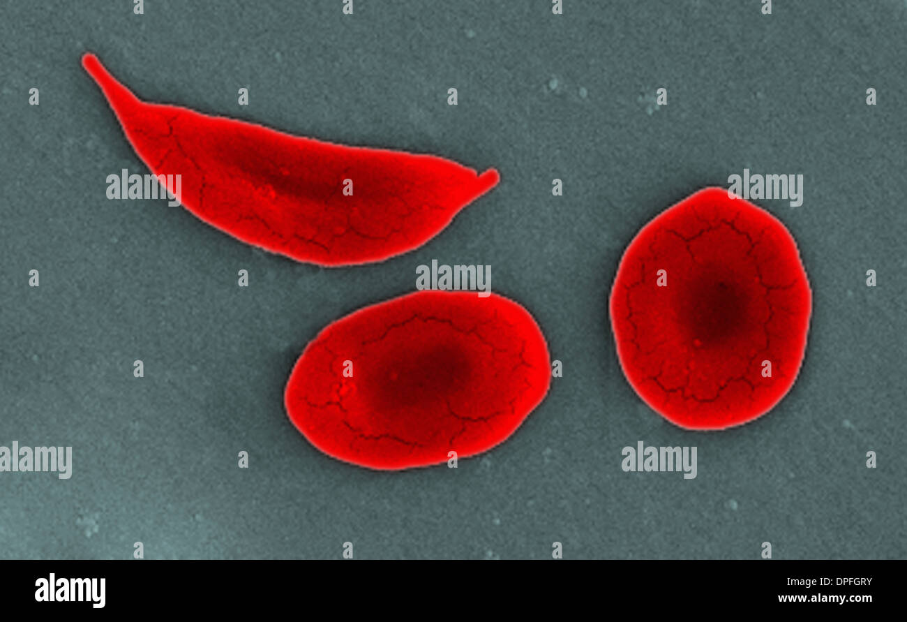 SEM de la drépanocytose et les globules rouges normaux Banque D'Images