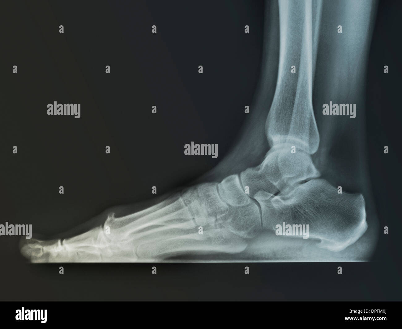 Pied normal x-ray d'une femme de 59 ans Banque D'Images