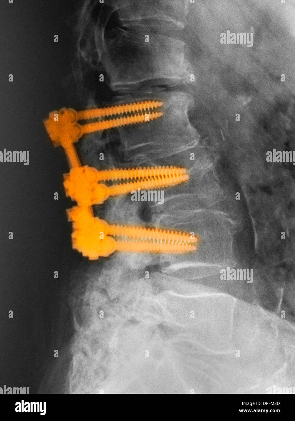 Avec l'arthrodèse lombaire hardware Banque D'Images