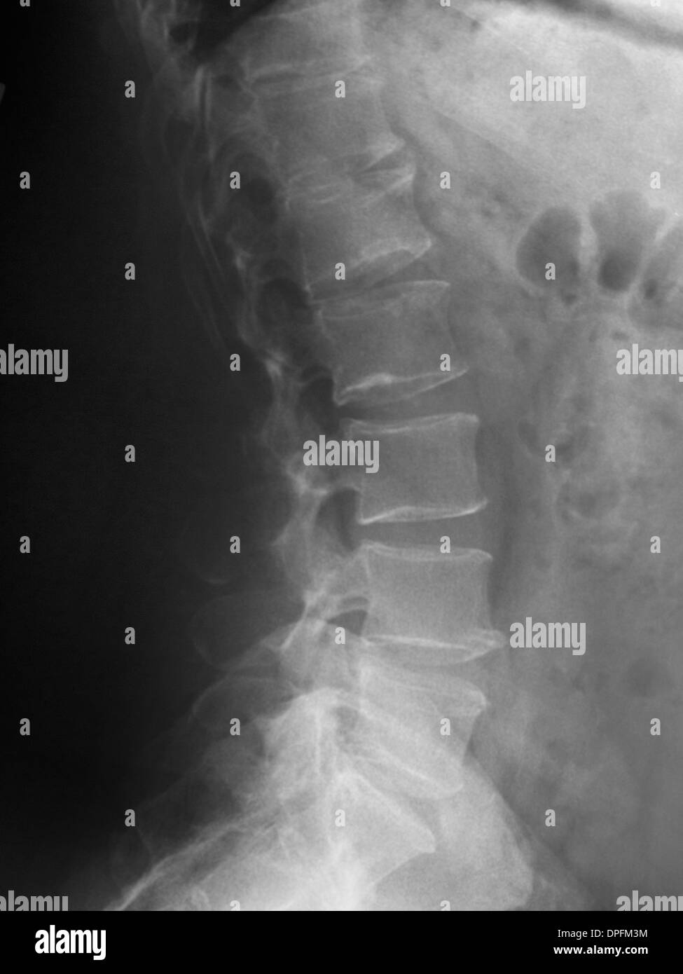 Colonne lombaire x-ray of a 41 year old man Banque D'Images