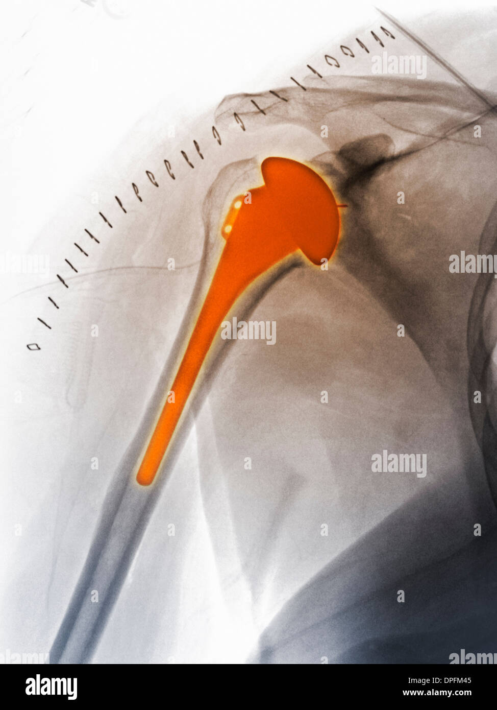X-ray de remplacement de l'épaule d'une femme de 51 ans Banque D'Images