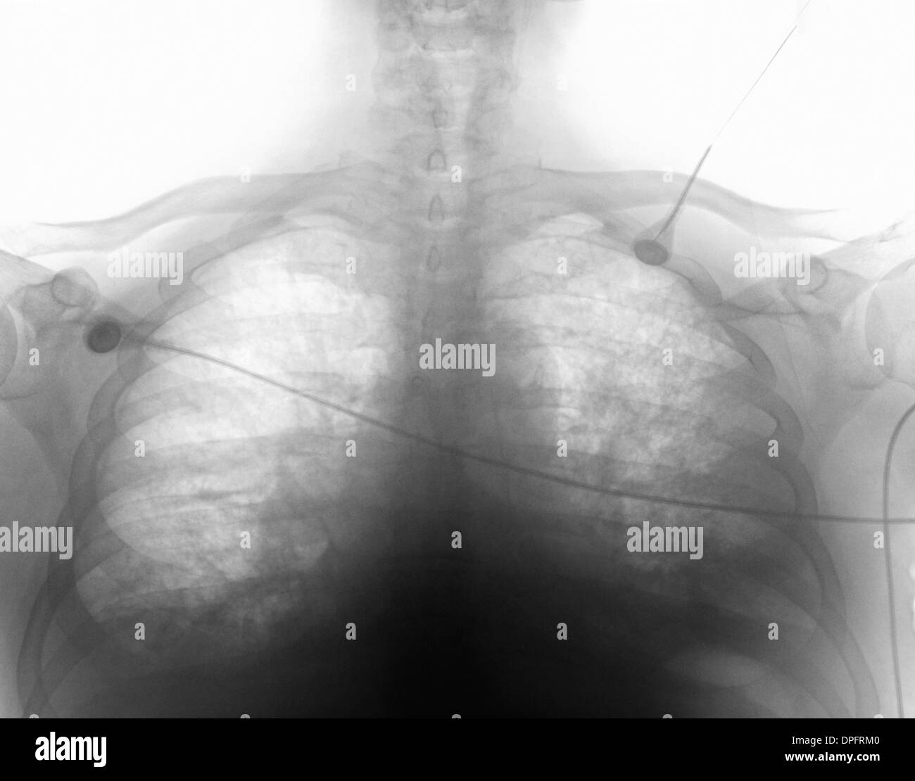 Radiographie de l'insuffisance cardiaque. Banque D'Images