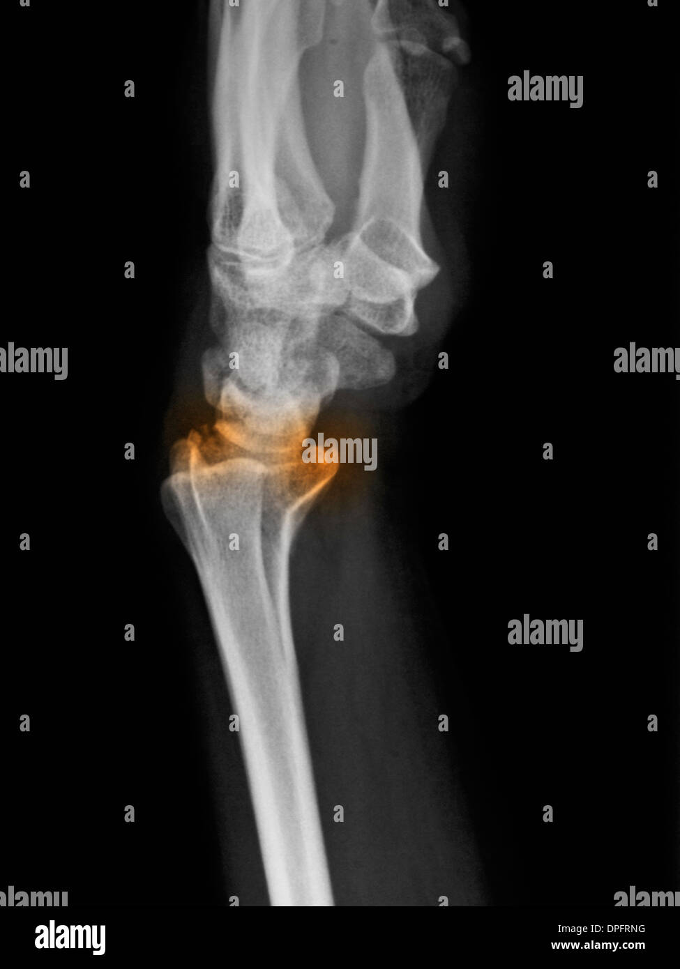 Radiographie d'une fracture du radius distal Banque D'Images
