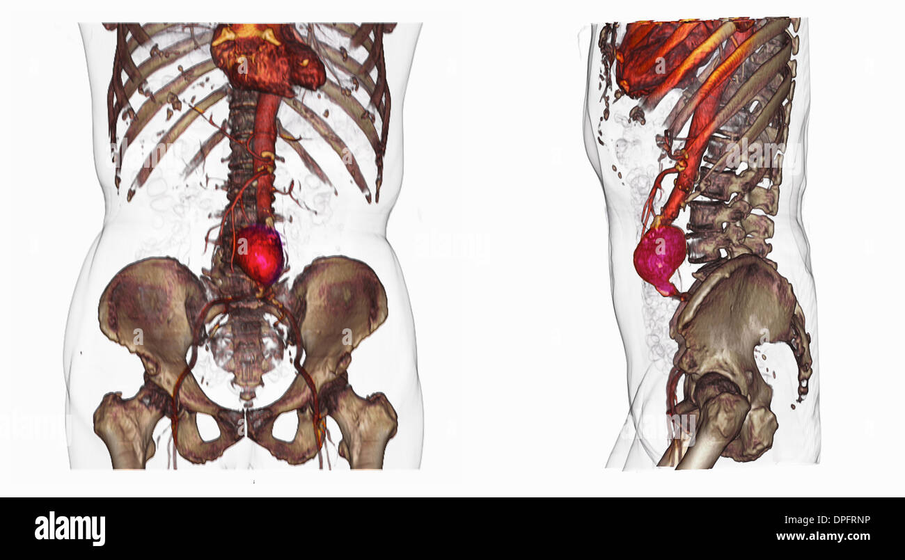Deux images CT scan d'un anévrisme de l'aorte abdominale Banque D'Images