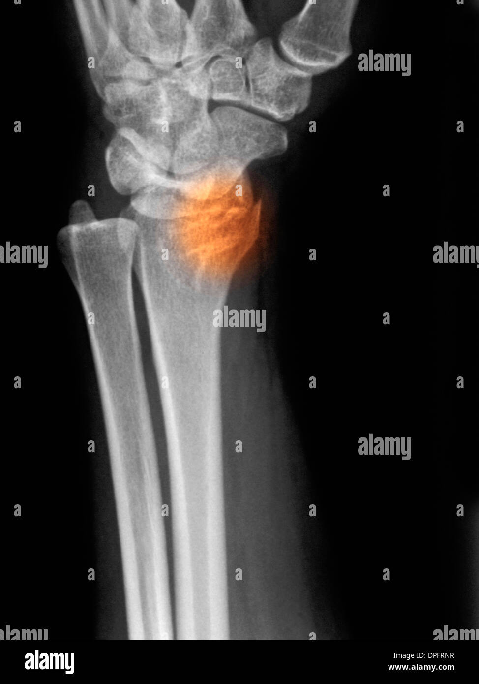 X-ray montrant une fracture du radius distal Banque D'Images