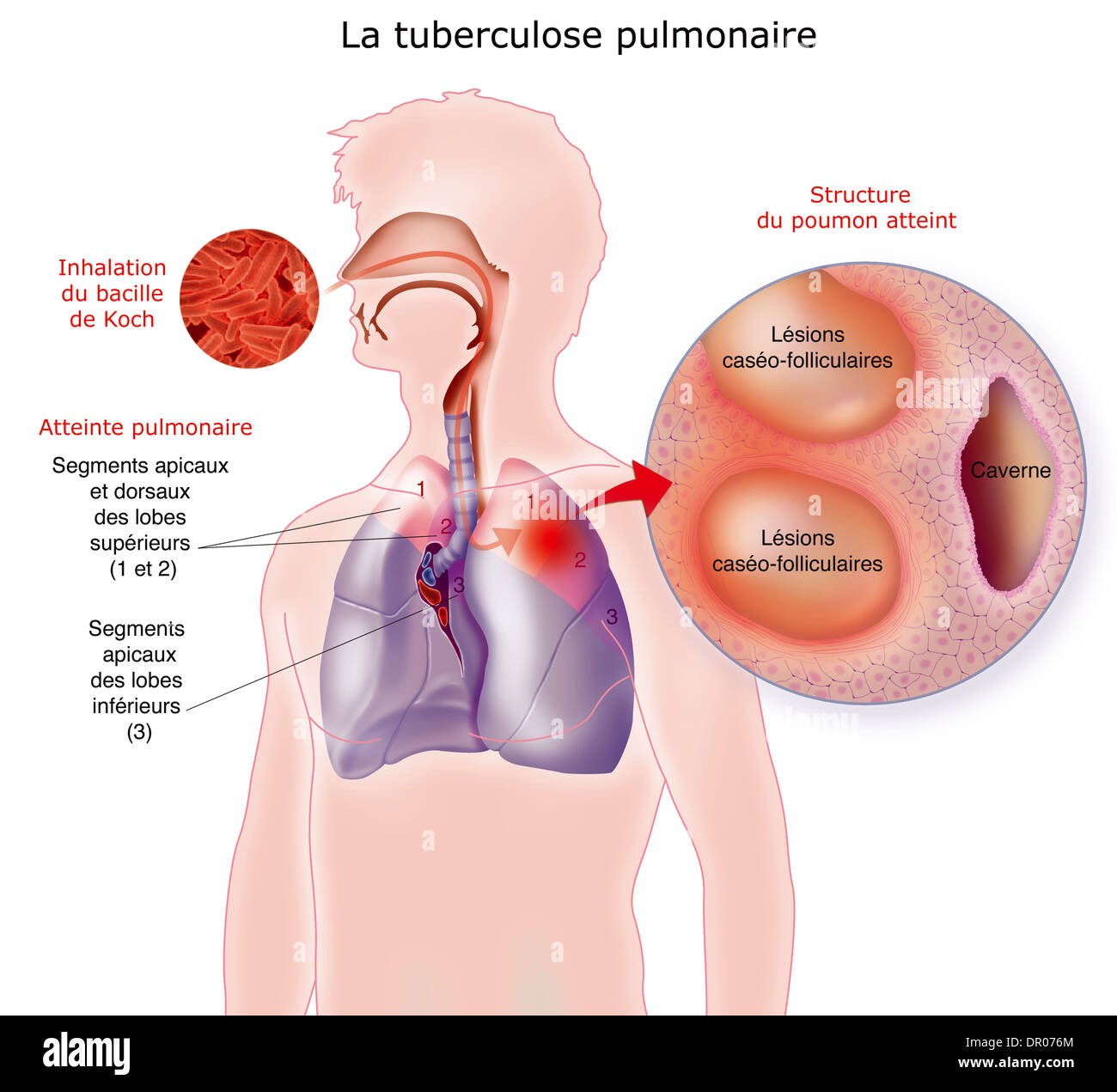 La tuberculose pulmonaire, dessin Banque D'Images
