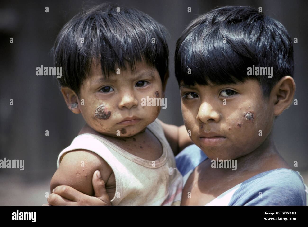 Impetigo Banque D Image Et Photos Alamy Impetigo Banque D Image Et Photos Alamy