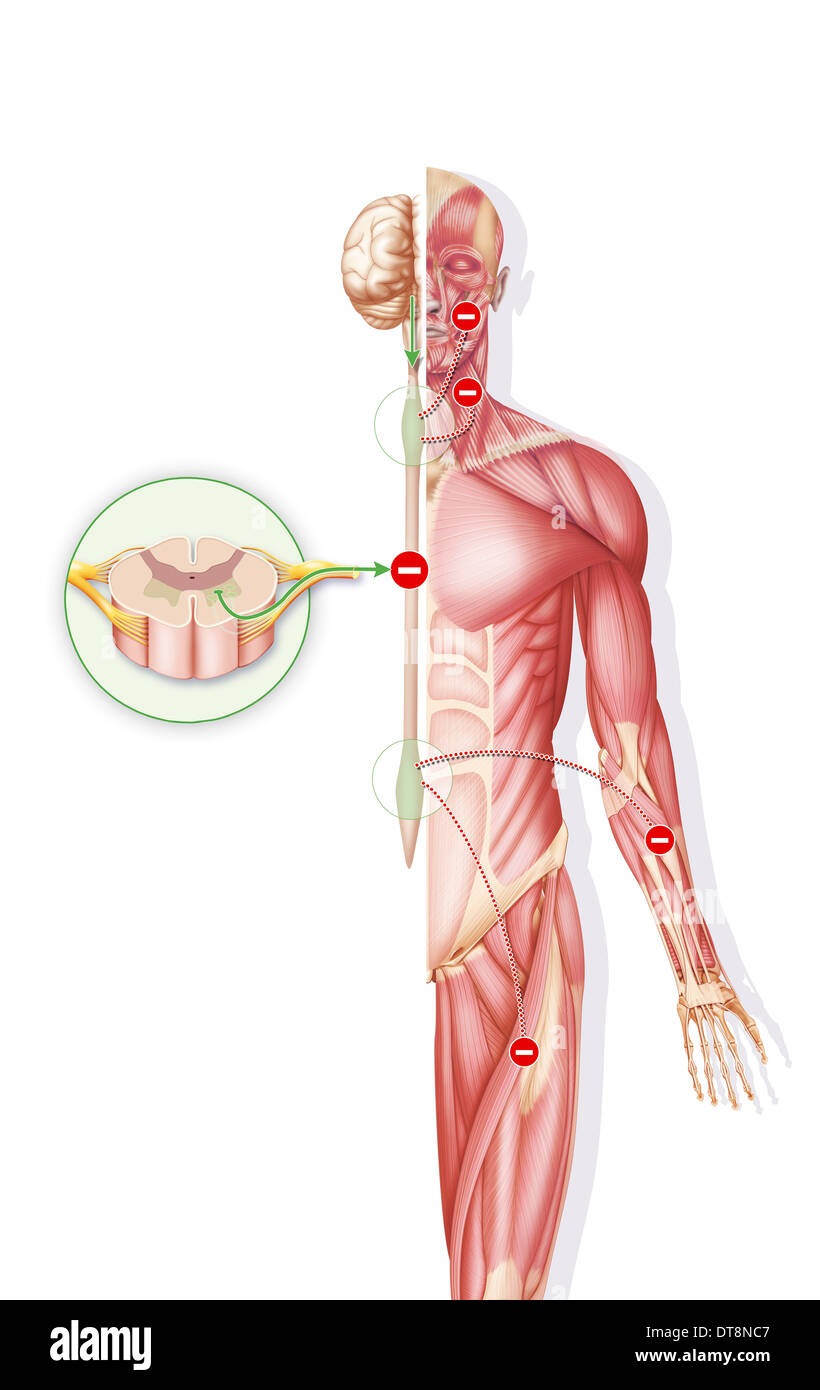 Atrophie musculaire spinale Banque de photographies et d’images à haute — free download