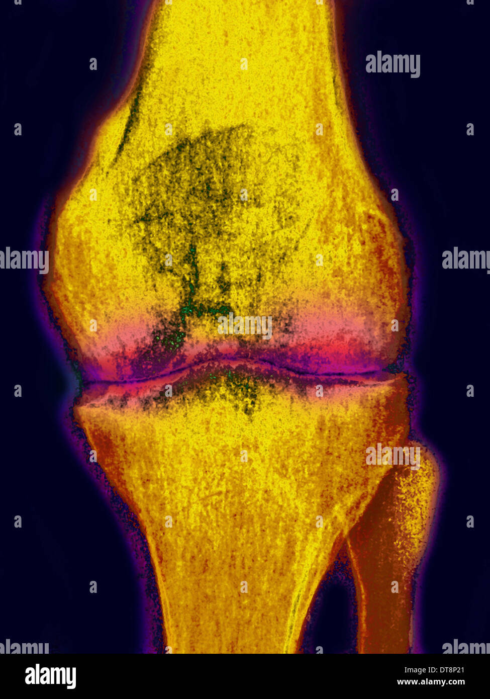 L'arthrite rhumatoïde, l'X-RAY Banque D'Images