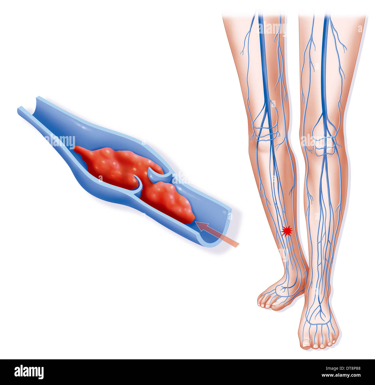 La thrombose profonde de veine Banque D'Images