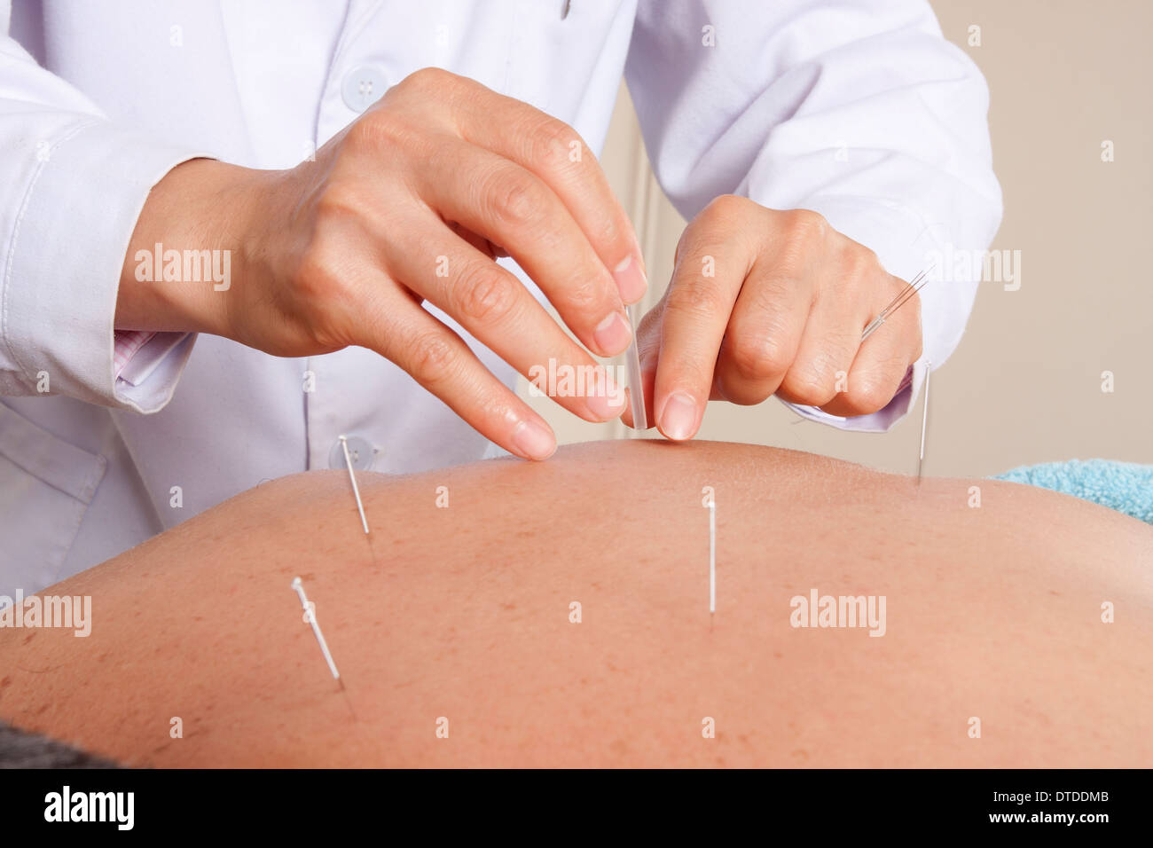 Homme ayant un traitement d'acupuncture pour la douleur dorsale Banque D'Images