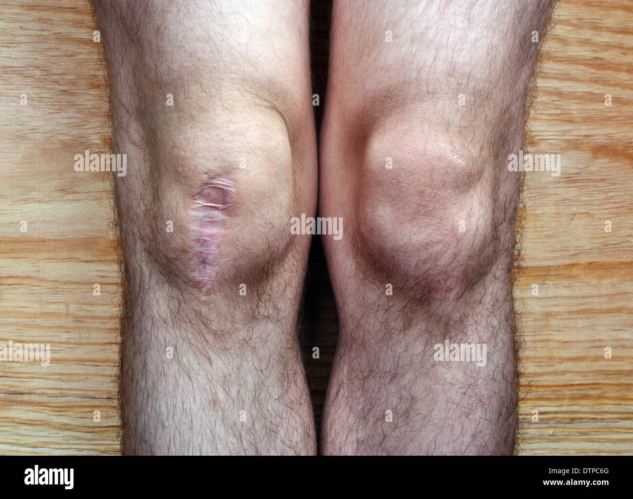 La cicatrice sur son genou à la jambe après la chirurgie à l'hôpital Banque D'Images
