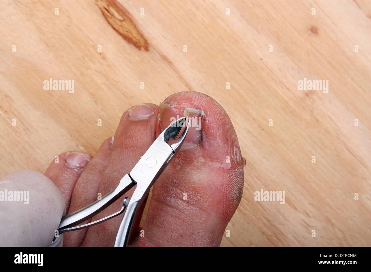 Chirurgie sur un ongle d'orteil cassé un homme Banque D'Images