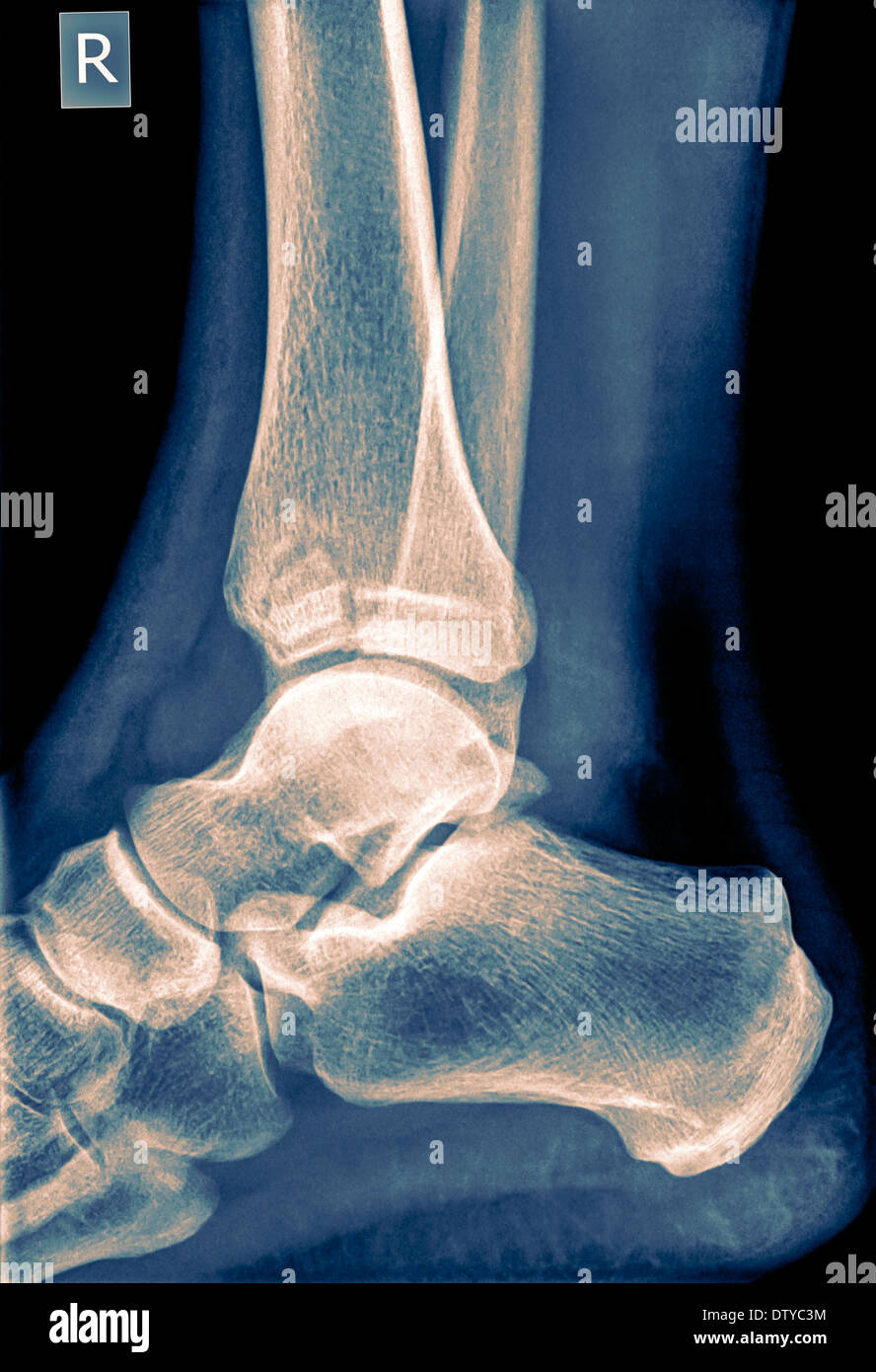 X-ray d'une cheville 50 ans homme avec une fracture du tibia. Vue de côté Banque D'Images