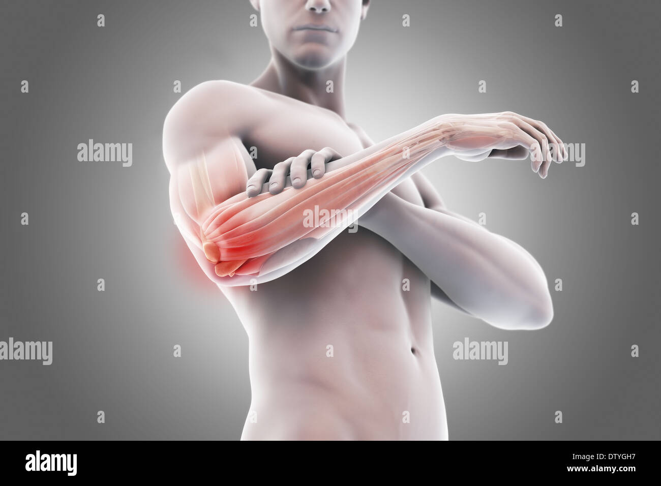 Tennis Elbow Banque D'Images