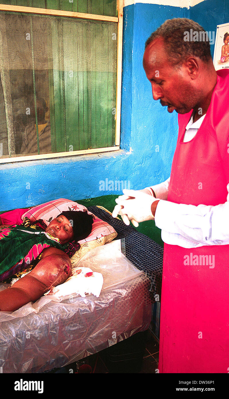 Femme avec bras dans la tumeur est traité à Galkayo Somalie hôpital Banque D'Images