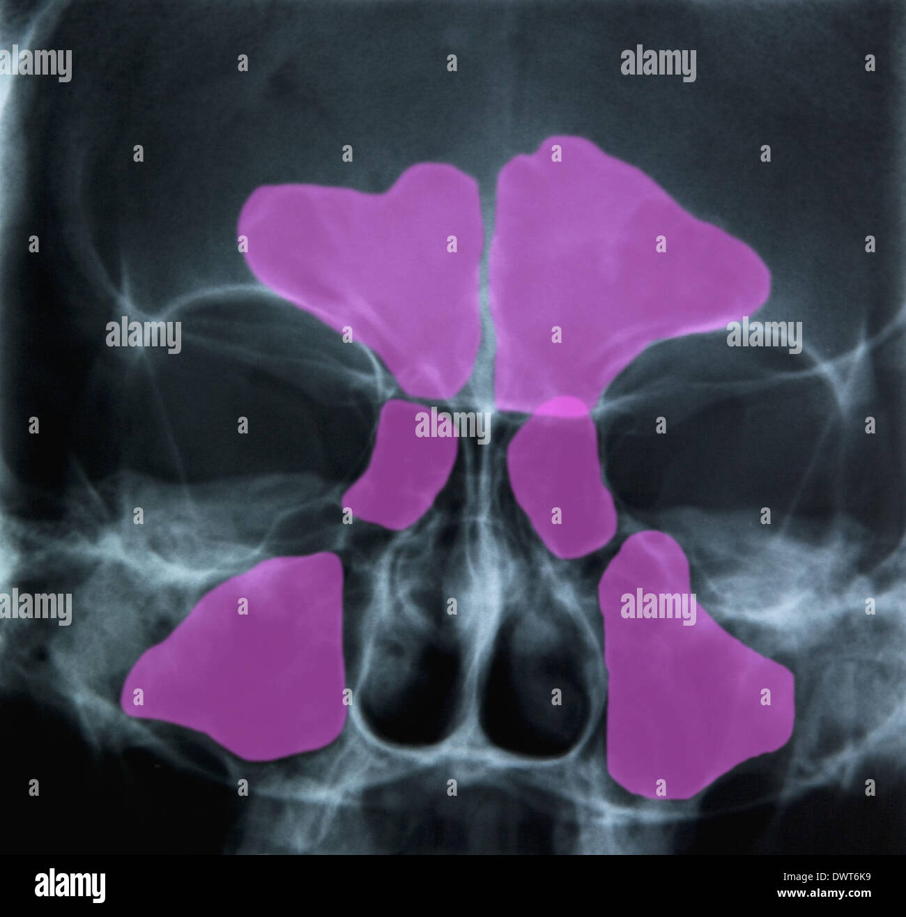 Sinus x-ray Banque D'Images