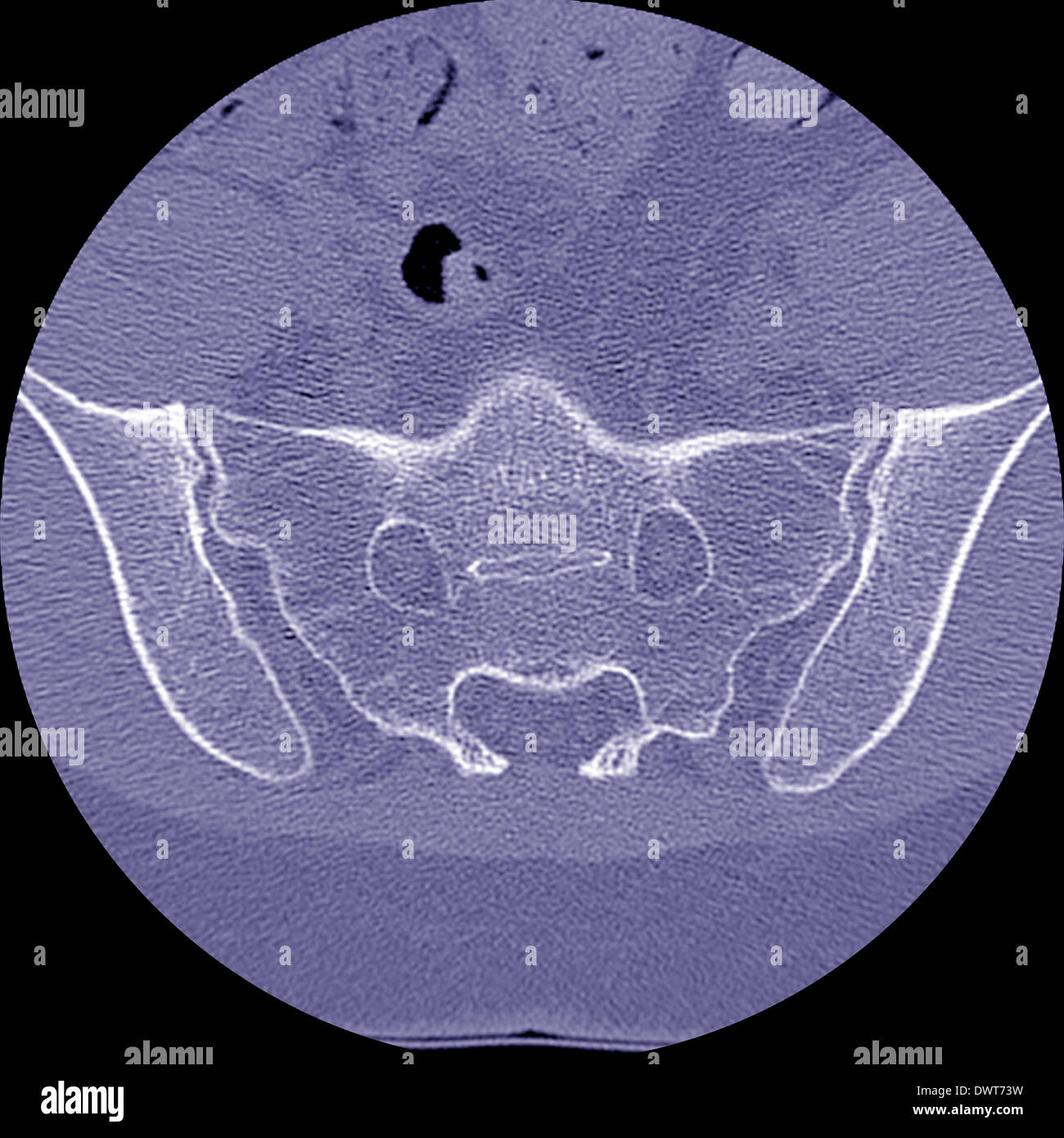 Articulation sacroiliaque du scanner Photo Stock Alamy