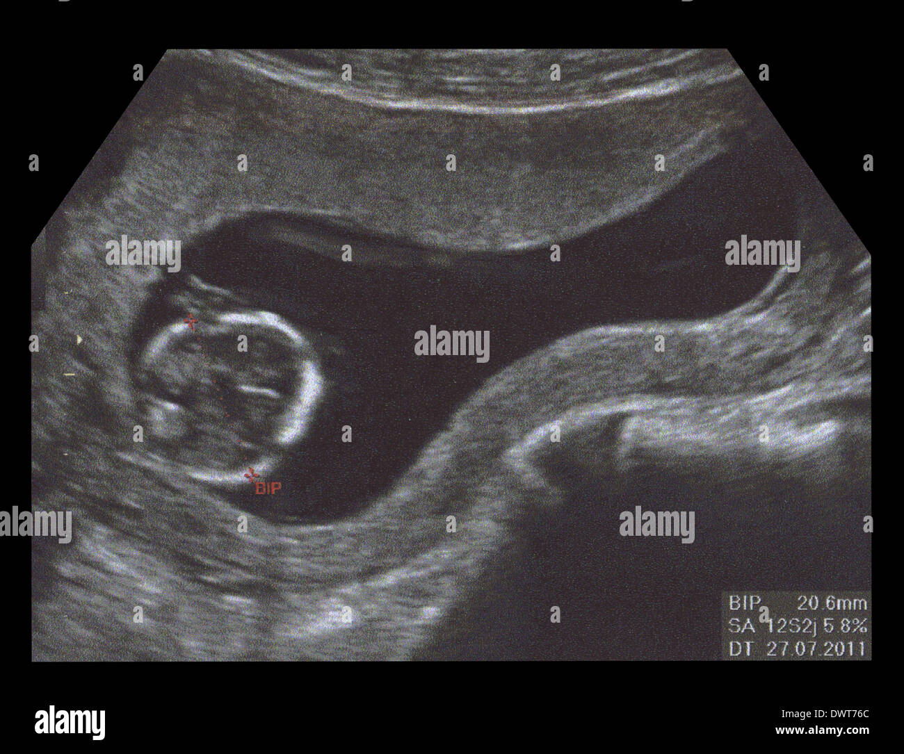 Echographie Foetus Photo Stock Alamy