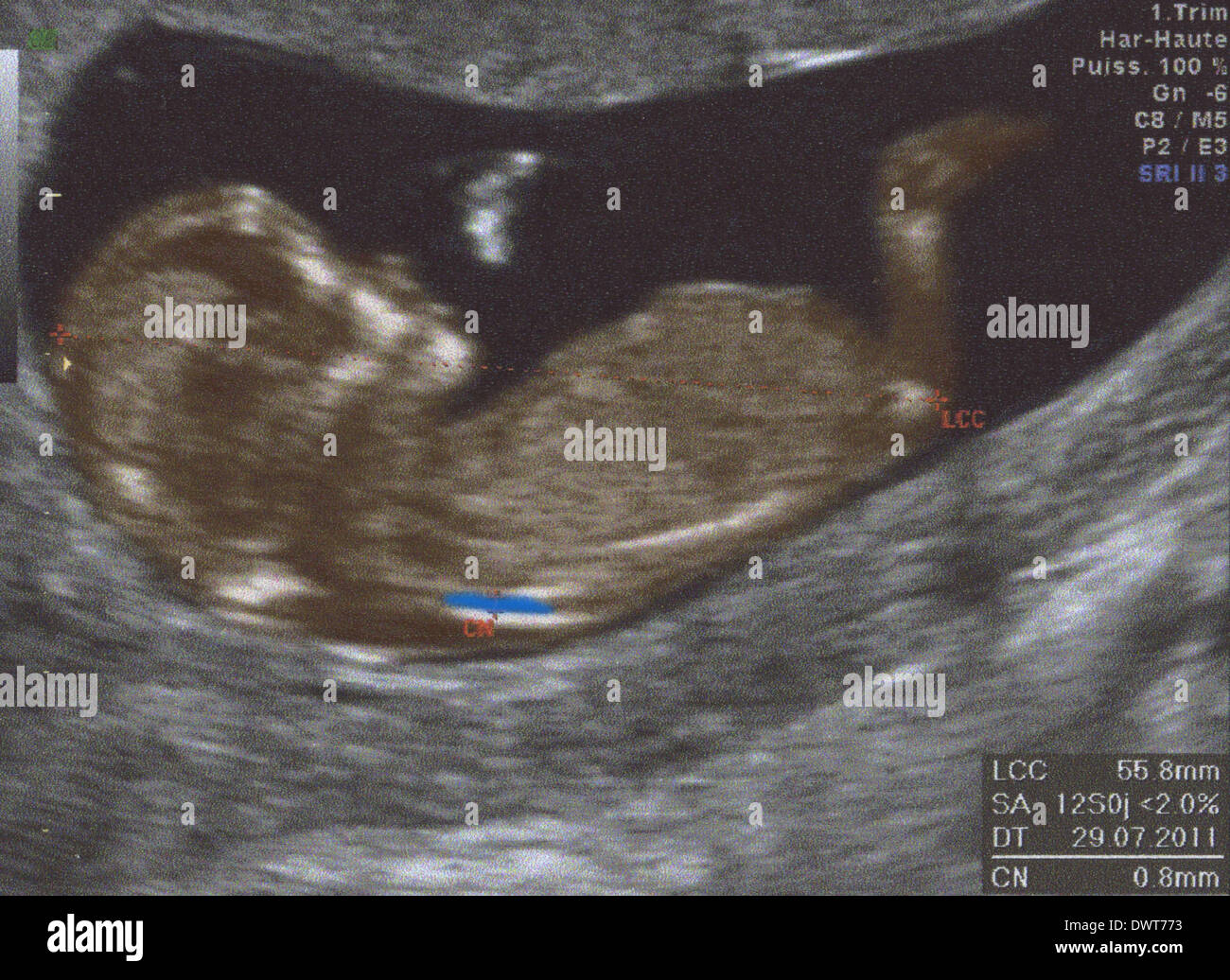 Echographie Foetus Photo Stock Alamy