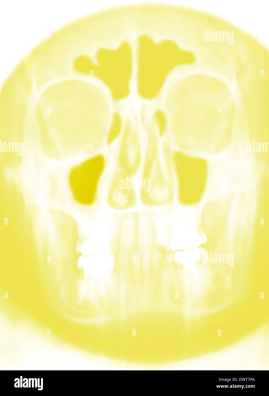 Tomodensitométrie des sinus Banque D'Images