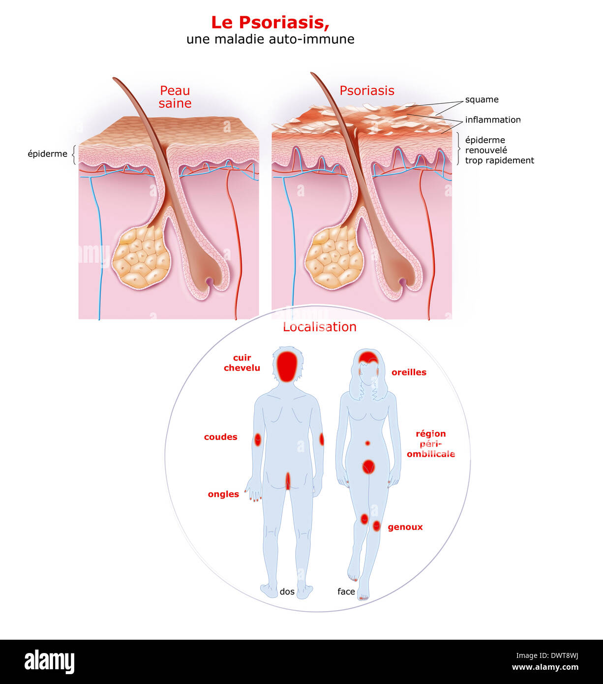 Le psoriasis, l'encombrement Banque D'Images