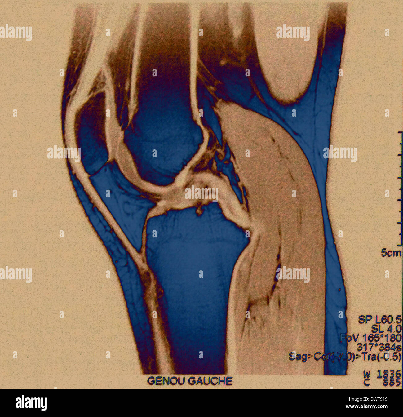 Ligament humain du genou Banque de photographies et d’images à haute ...