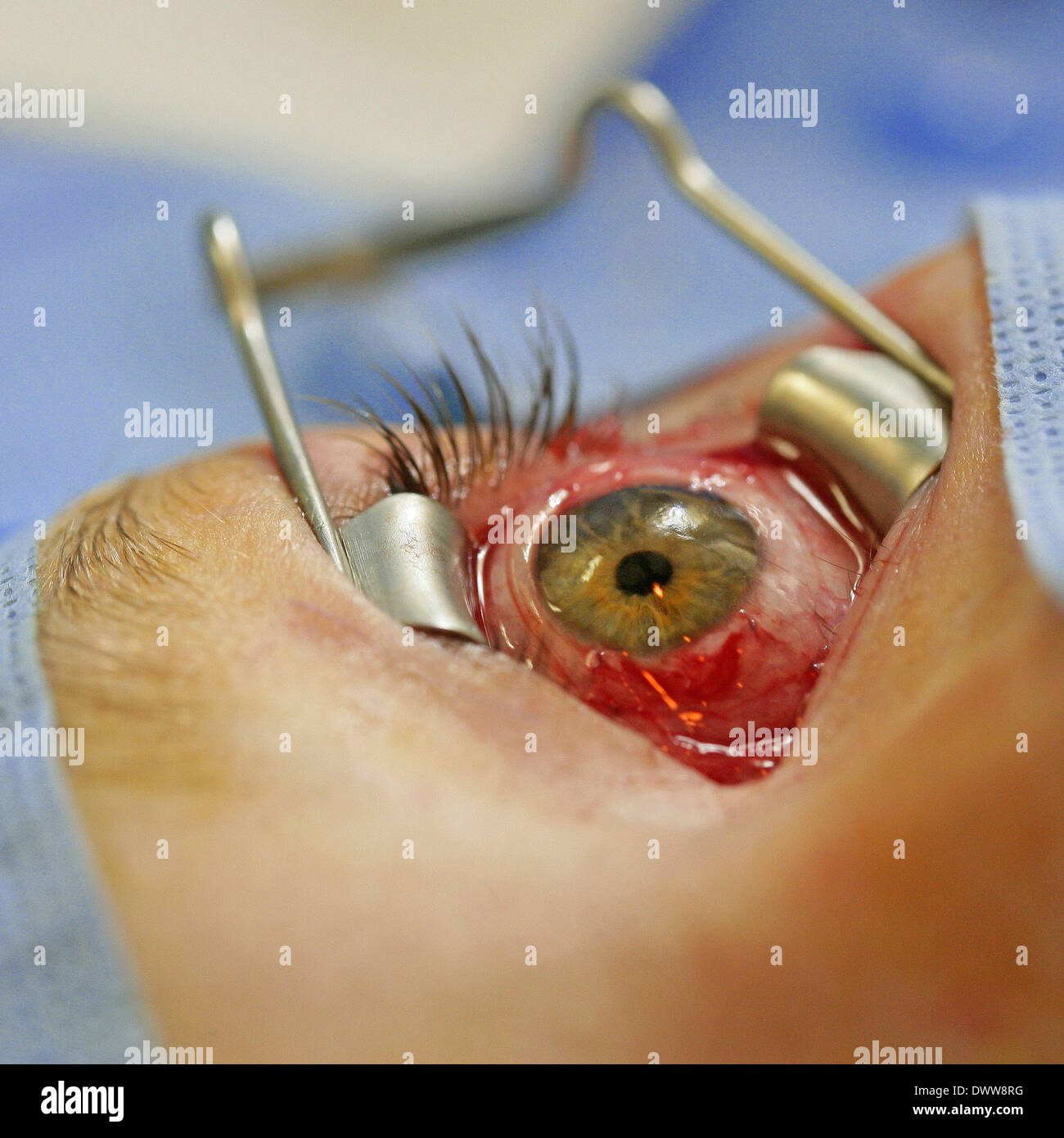 Le strabisme Chirurgie Photo Stock - Alamy