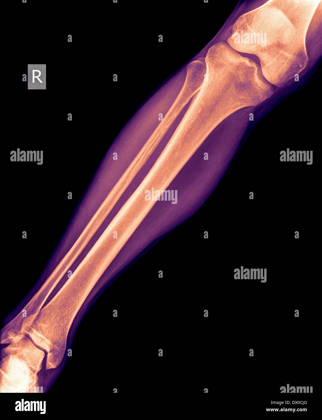 X-ray de la jambe 50 ans homme avec une fracture tibia vue latérale Banque D'Images