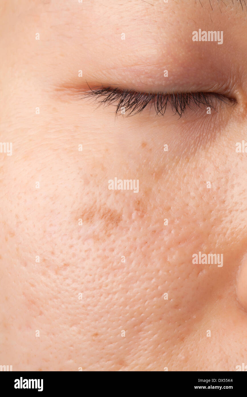 Les femmes avec le scar face huileuse et problème de peau Banque D'Images