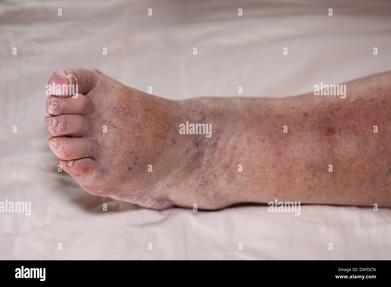 Détail de la mauvaise jambe enflée féminine senior avec les orteils et les ongles endommagés. Banque D'Images