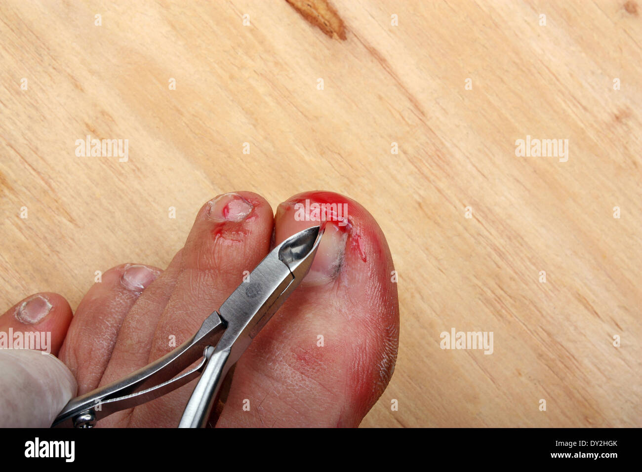 Chirurgie sur un ongle d'orteil cassé purge un homme Banque D'Images