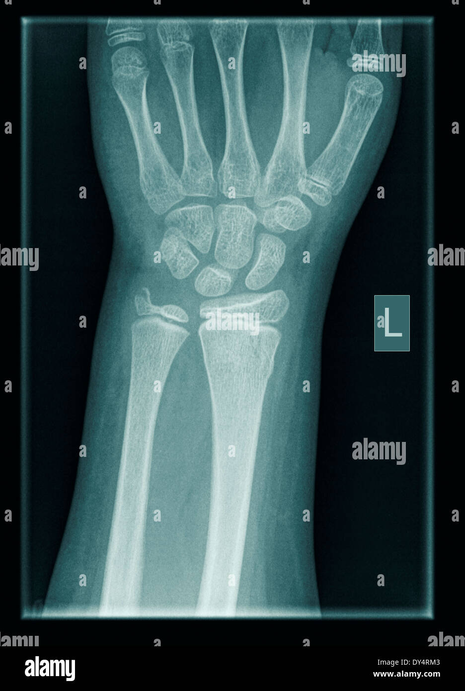 X-ray de poignet de 9 ans homme patient avec les fractures de la partie distale du radius et cubitus Banque D'Images