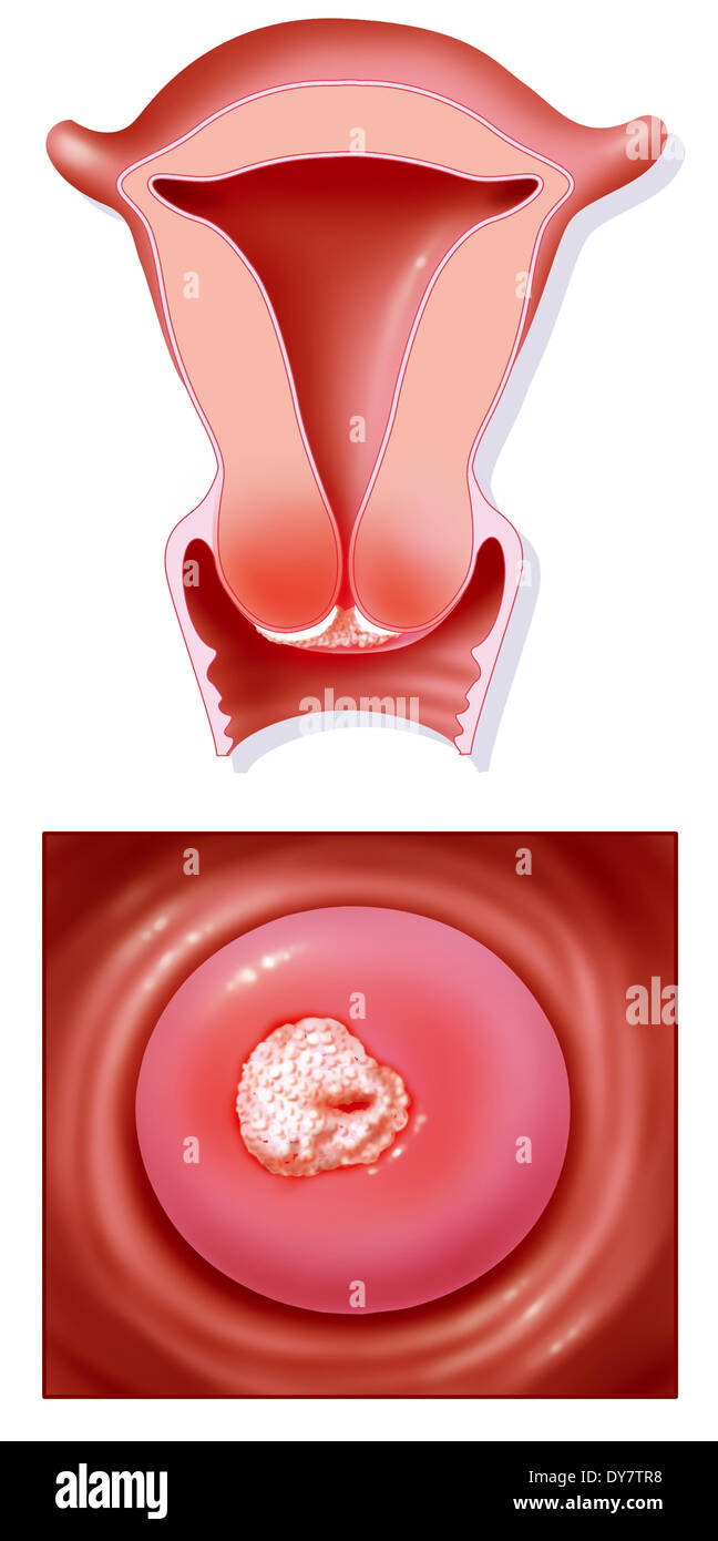 Le cancer du col de l'utérus, dessin Banque D'Images