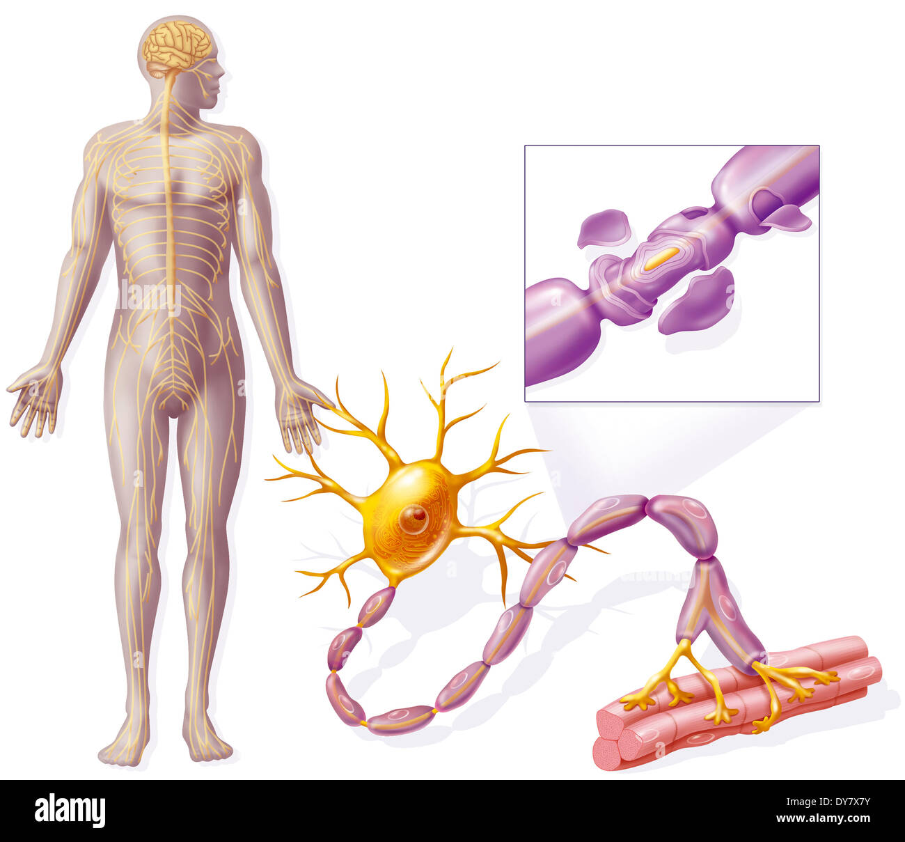 La sclérose en plaques Banque D'Images