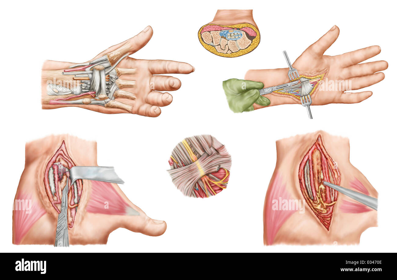 Illustration médicale montrant un syndrome du tunnel carpien dans le poignet humain, et les procédures chirurgicales qui lui sont associés. Banque D'Images