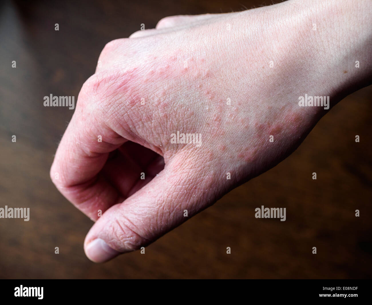 Atopic eczema Banque de photographies et d’images à haute résolution