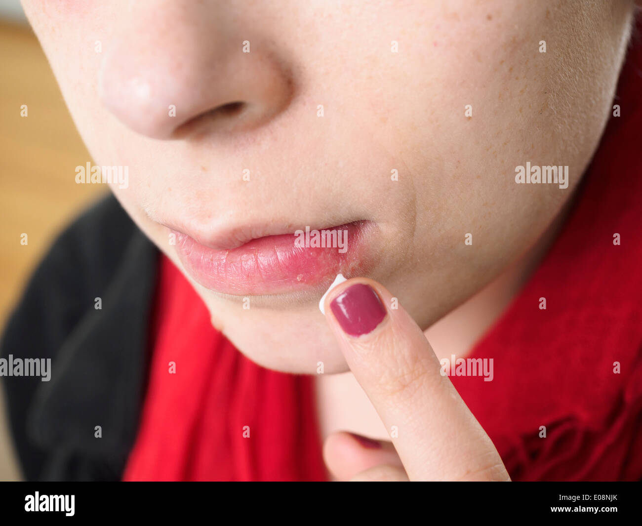 Jeune femme mettant en onguent sur la lèvre avec le virus herpès simplex Banque D'Images