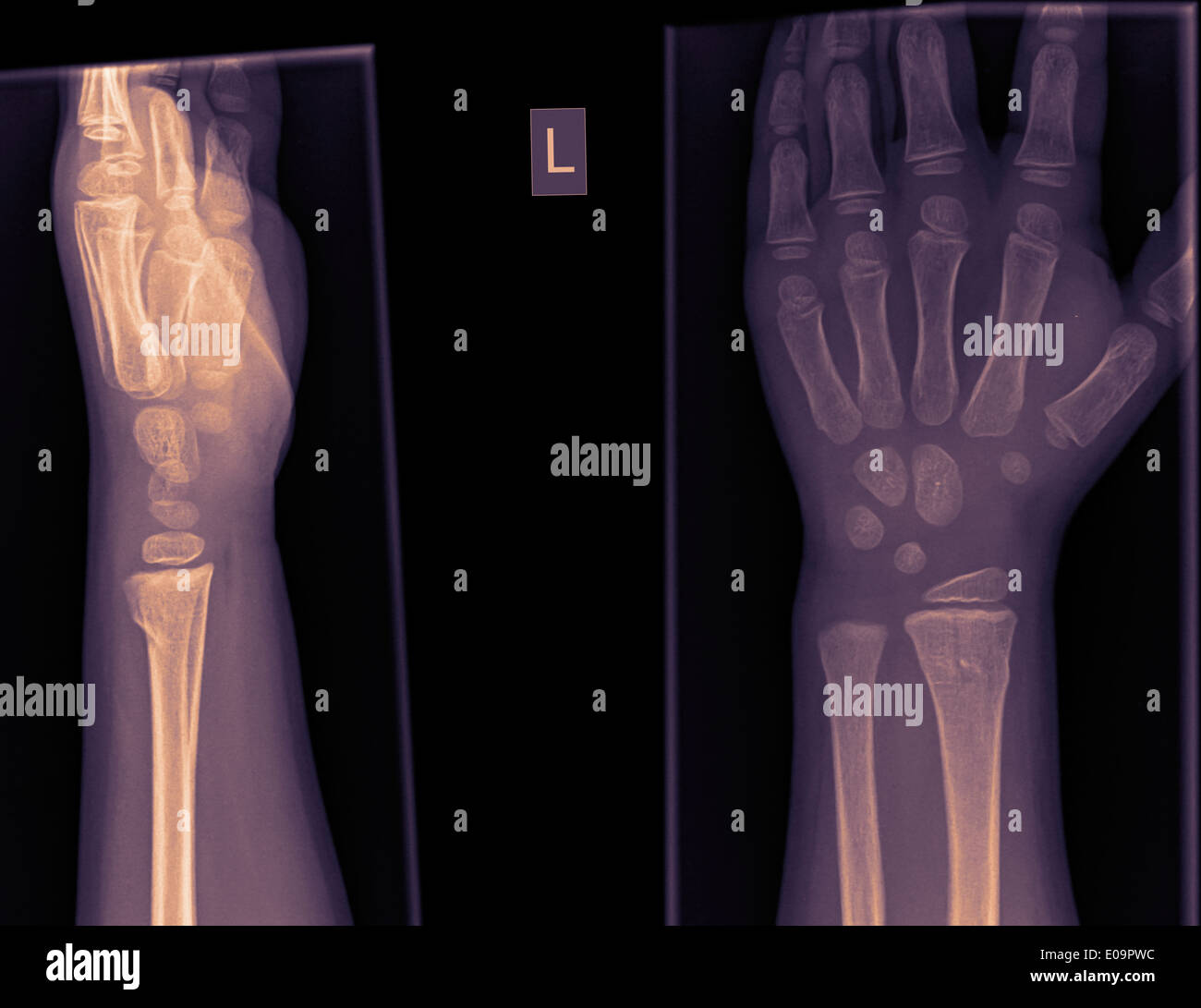 Poignet et main radiographie d'un enfant de 4 ans mâle avec une fracture du radius distal Banque D'Images