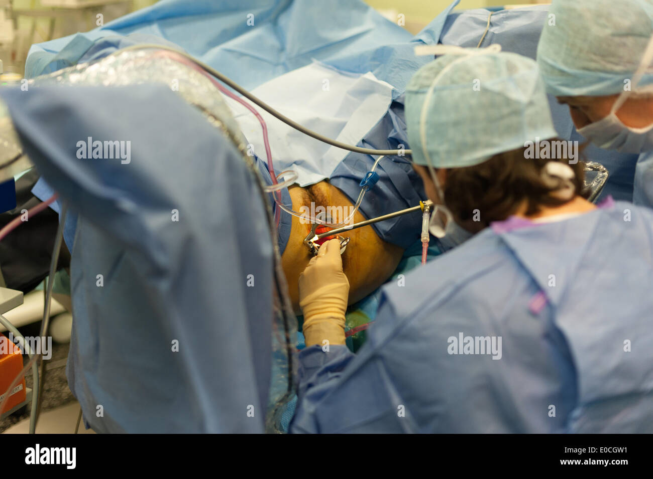 übernimmt Die Aok Die Kosten Einer Operation Gynäkomastie La chirurgie gynécologique Photo Stock - Alamy