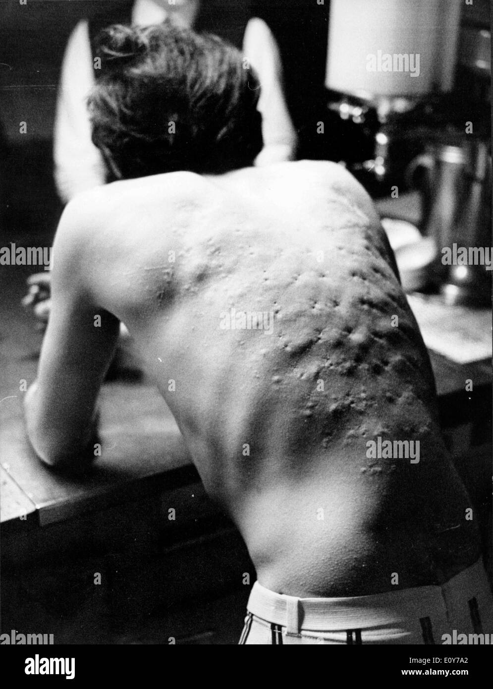 Mar 24, 1969 ; Zurich, Suisse ; l'arrière de ce fakir a été fortement endommagé après les 2 heures et 19 minutes sur la table d'ongle. Banque D'Images