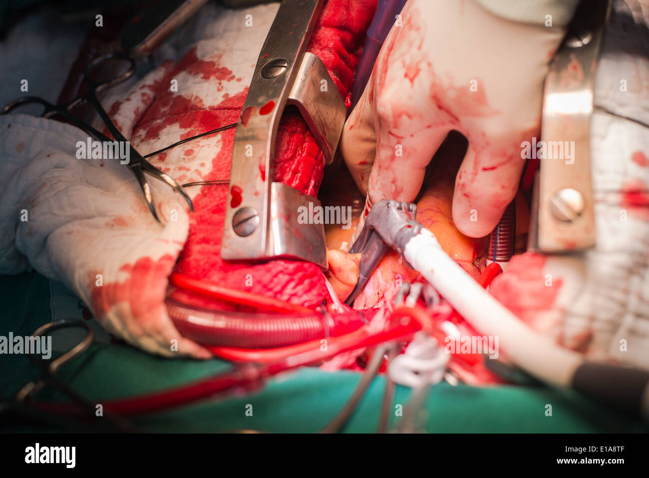 En bipolaire gauche bloquer la fibrillation auriculaire de la réparation Banque D'Images