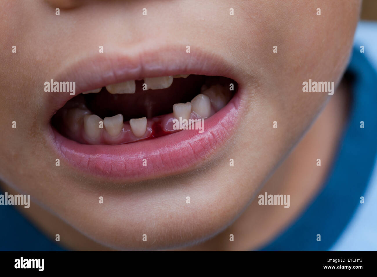Premiere Dent Banque D Image Et Photos Alamy