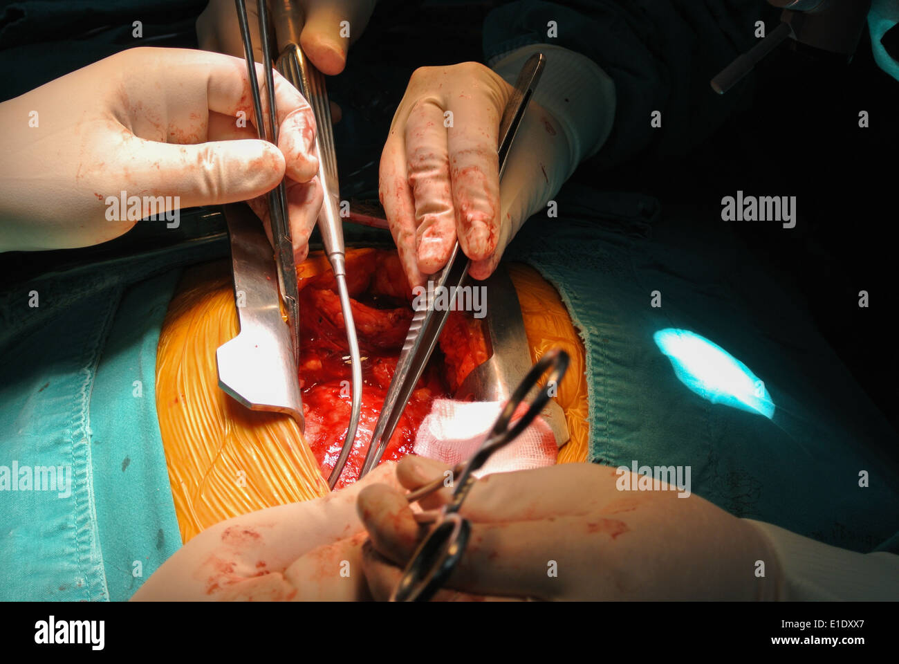 tumeur cardiaque Banque D'Images