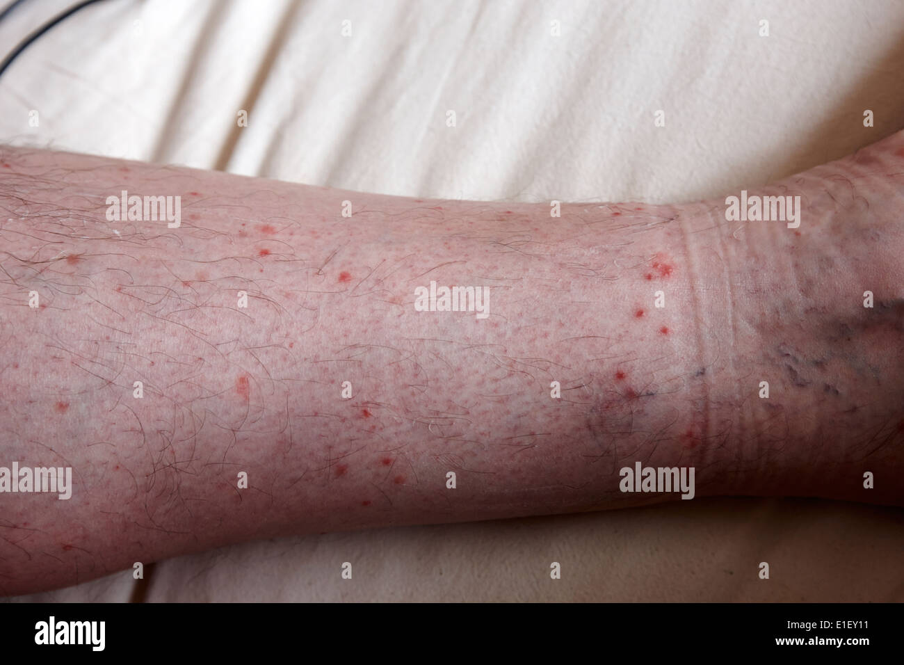 Piqure De Puce Banque De Photographies Et D Images A Haute Resolution Alamy