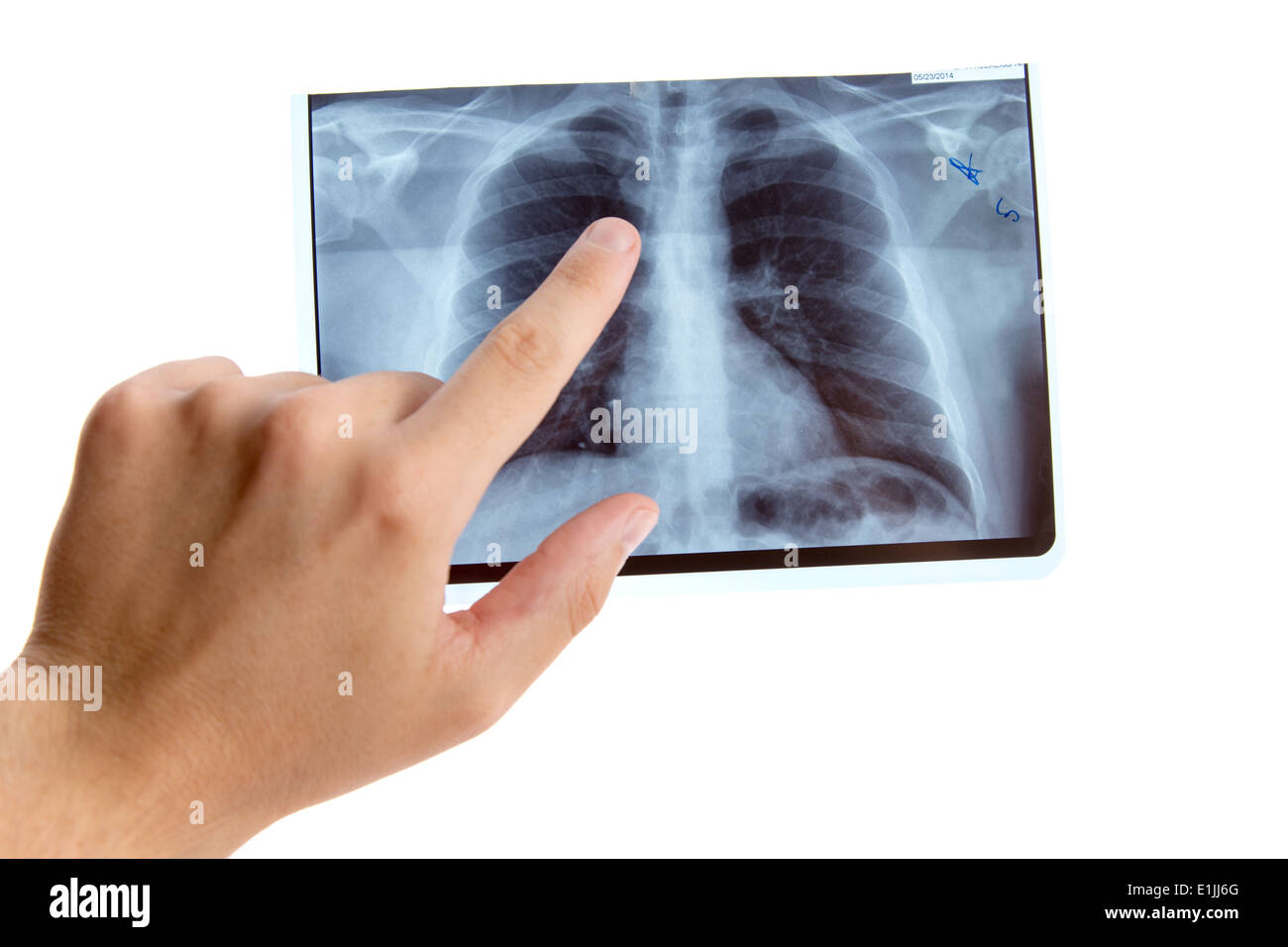 Homme main pointant sur la radiographie pulmonaire, isolé sur fond blanc Banque D'Images
