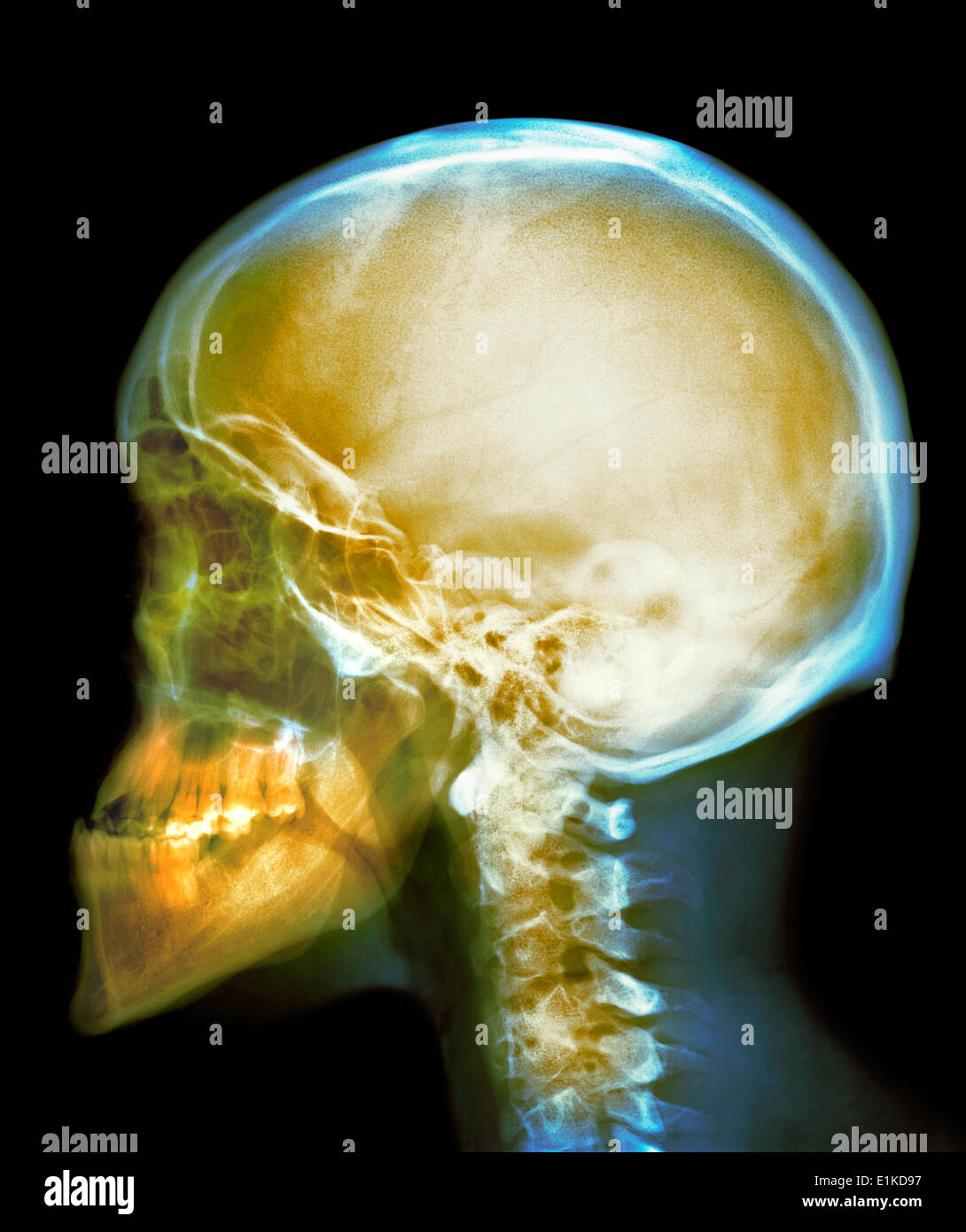 X-ray de couleur du crâne du crâne d'un homme de 30 ans. Banque D'Images