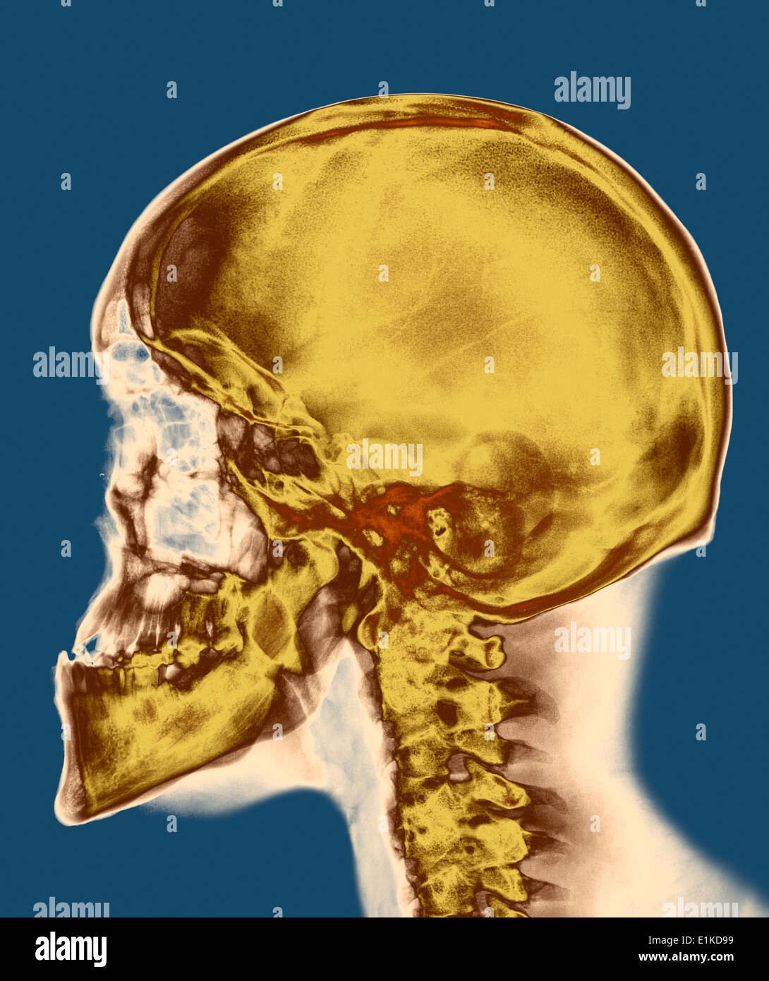 X-ray de couleur du crâne du crâne d'un homme de 30 ans. Banque D'Images